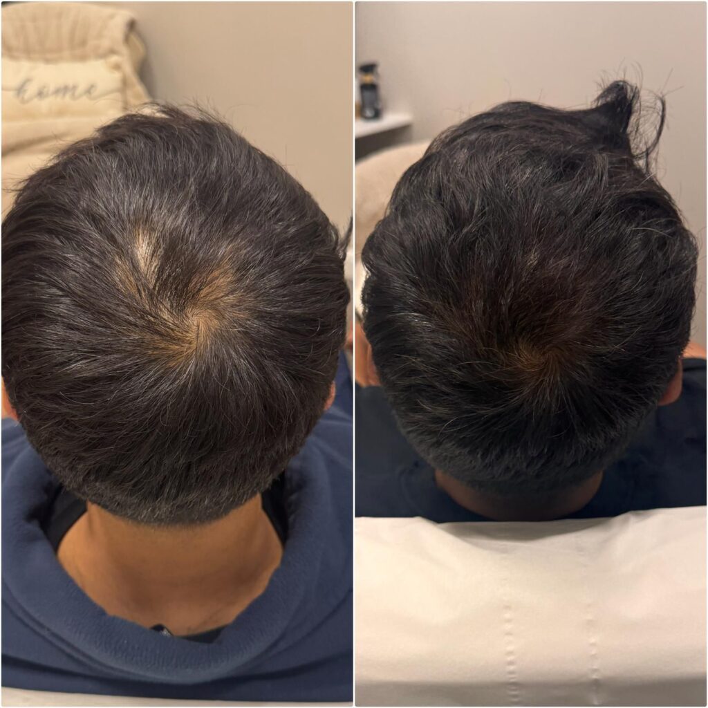 2 sessions of PRP microneedling