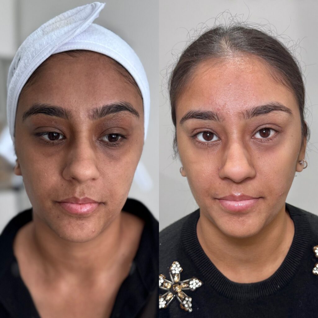 2 sessions of PRP microneedling