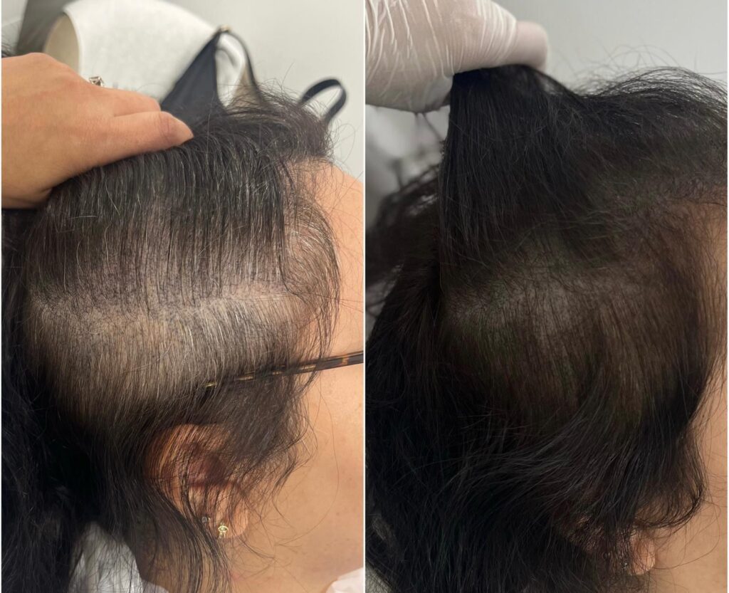 2 sessions of PRP microneedling