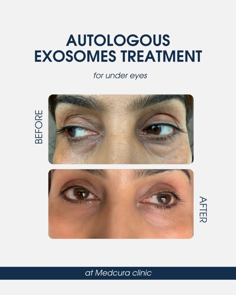 Autologous Exosomes for Face & Hair